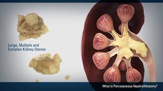 Percutaneous Nephrolithotomy PCNL [upl. by Isa]