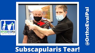 Subscapularis Rotator Cuff Tear [upl. by Nnylanna]