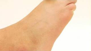 How To Cure Hallux Rigidus [upl. by Laitselec]