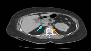 Clinical Case Renal Cell Carcinoma [upl. by Arraet]