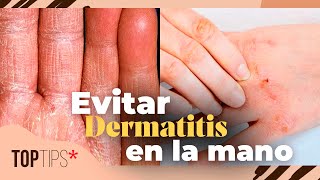 Hongos En Las Manos Cómo Evitar La Dermatitis  Top Tips [upl. by Swagerty]