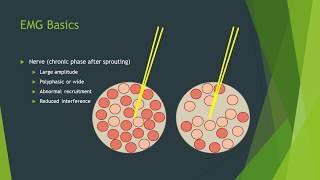 Myopathy EMG changes explained [upl. by Stultz]