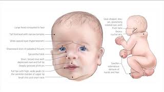 Noonan syndrome [upl. by Schnapp]