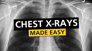 Chest X Rays CXR Made Easy  Learn in 10 Minutes [upl. by Doloritas]