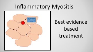 Myositis Inflammatory Myopathy Treatment [upl. by Yasmine345]