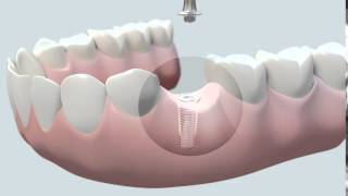 Cómo se coloca un implante dental [upl. by Danaher]