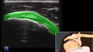 How To Shoulder Subscapularis Tendon 3D Video [upl. by Asil]