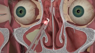 A nasal irrigation technique using a medical syringe ENG SUB [upl. by Celle]