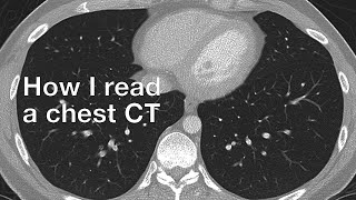 How I Read a Chest CT [upl. by Lello699]