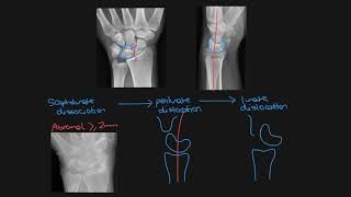 Carpal bone fractures [upl. by Evaleen]