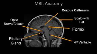 Normal Brain MRI Anatomy  Neuroradiology Made simple [upl. by Serrano]