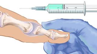 First Metatarsophalangeal Joint Injection [upl. by Airdnaxela]