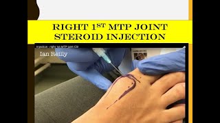 Injection  right 1st MTP joint CSI [upl. by Peacock811]