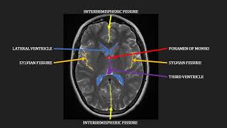 Introduction to MRI of the brain [upl. by Acsot]