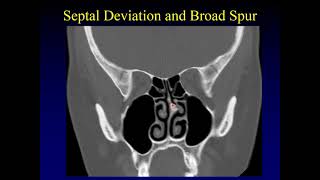 Sinus Infection Causes Signs Symptoms Diagnosis  Dr Harihara Murthy [upl. by Sass]