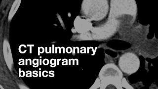 Pulmonary CT Angiogram Basics [upl. by Ibbor235]