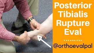 Posterior Tibialis Rupture Evaluation [upl. by Tiemroth]