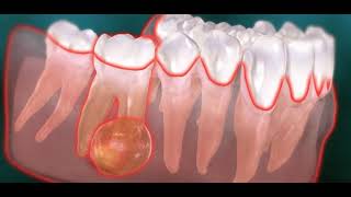 Abcès endodontique dentaire kyste [upl. by Keraj]