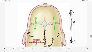 Craniosynostosis [upl. by Eduino]