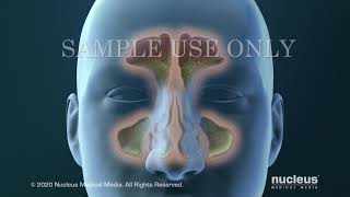 Sinusitis Surgery [upl. by Lynd660]