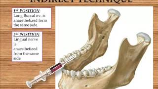 Inferior Alveolar Nerve Block [upl. by Cheng307]