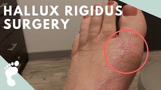 Hallux Rigidus Surgery [upl. by Anatsirhc]