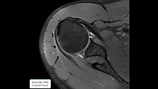 Shoulder MRI Labral Tear [upl. by Yanetruoc]