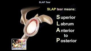 SLAP Tear  Everything You Need To Know  Dr Nabil Ebraheim [upl. by Murry]