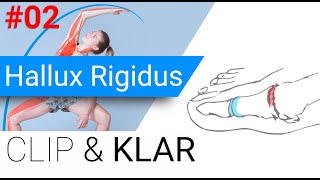 Hallux Rigidus erklärt  Arthrose im Grosszeh Grundgelenk [upl. by Noynek]