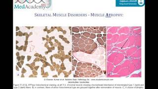 Treatment tips for inflammatory myopathy [upl. by Adelric]