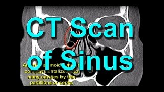 How To Read CT Sinus Scans Like An Expert [upl. by Meedan]