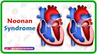 Noonan syndrome  Usmle step 1 [upl. by Lissy311]