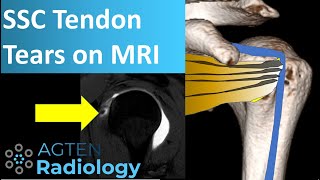 Subscapularis Tendon Tears on MRI [upl. by Alfons]