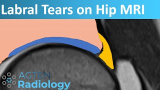 Labral Tears on Hip MRI [upl. by Dey]