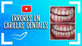 Errores en Carillas Dentales l Tallado Mal Sellado Muy Blancos [upl. by Rehpoitsirhc]