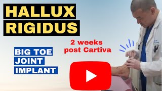 Hallux rigidus two weeks post Cartiva [upl. by Apurk]