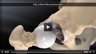 Hip Labral Reconstruction [upl. by Natanoj]