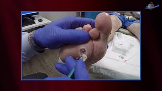 How To Perform Wound Vac Dressing Change [upl. by Skardol]