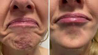 Botox Injections for Dimpled Uneven Puckered Orange Peel Chin [upl. by Lura435]