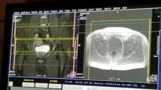 School of Medical Imaging MRI Lab  Hip [upl. by Kary]