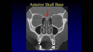 Anatomy and Functions of the Paranasal Sinuses [upl. by Ramedlaw]