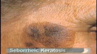 Common Skin Lesions [upl. by Gnap]