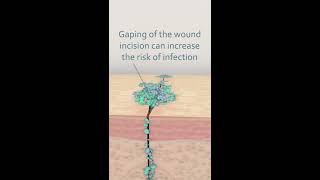 What causes wound infection [upl. by Sayre951]