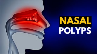 NASAL POLYPS Causes SIgns and Symptoms Diagnosis and Treatment [upl. by Ettie]