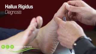 Hallux Rigidus Causes Diagnosis and Treatment [upl. by Marinna]