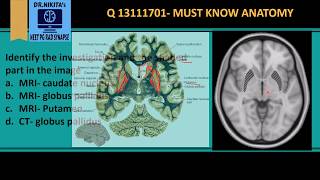 MRI Brain anatomy  Basal ganglia [upl. by Tnert]