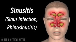 Sinusitis Animation [upl. by Martinic589]